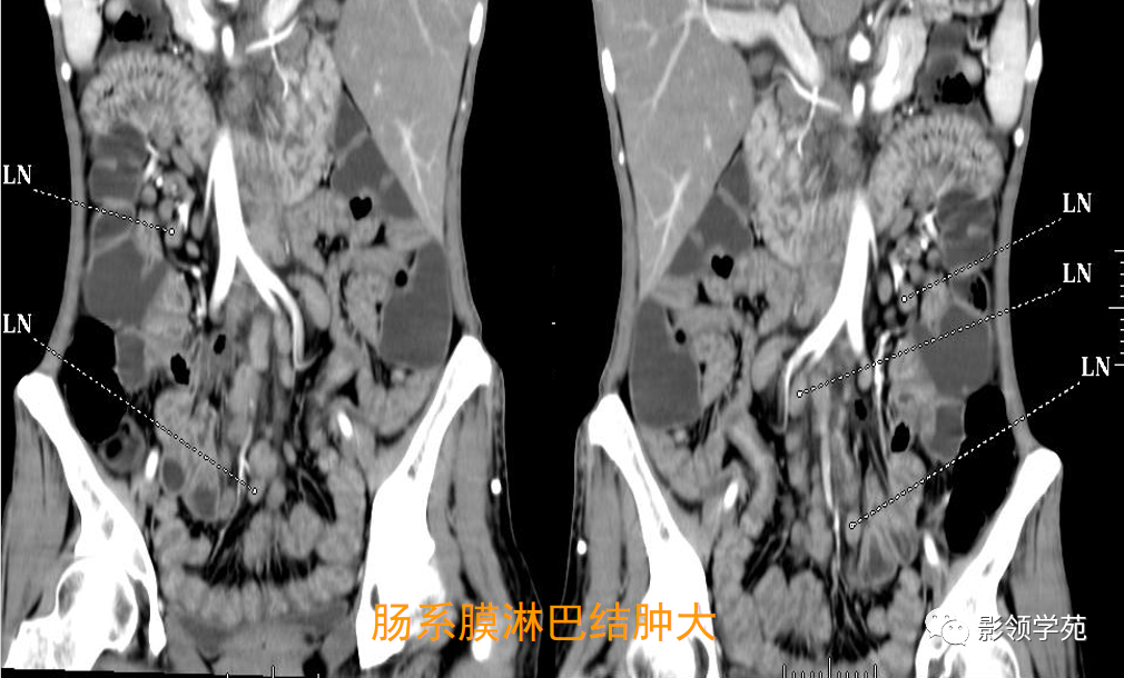 影像PPT - 炎症性肠病CT诊断-22