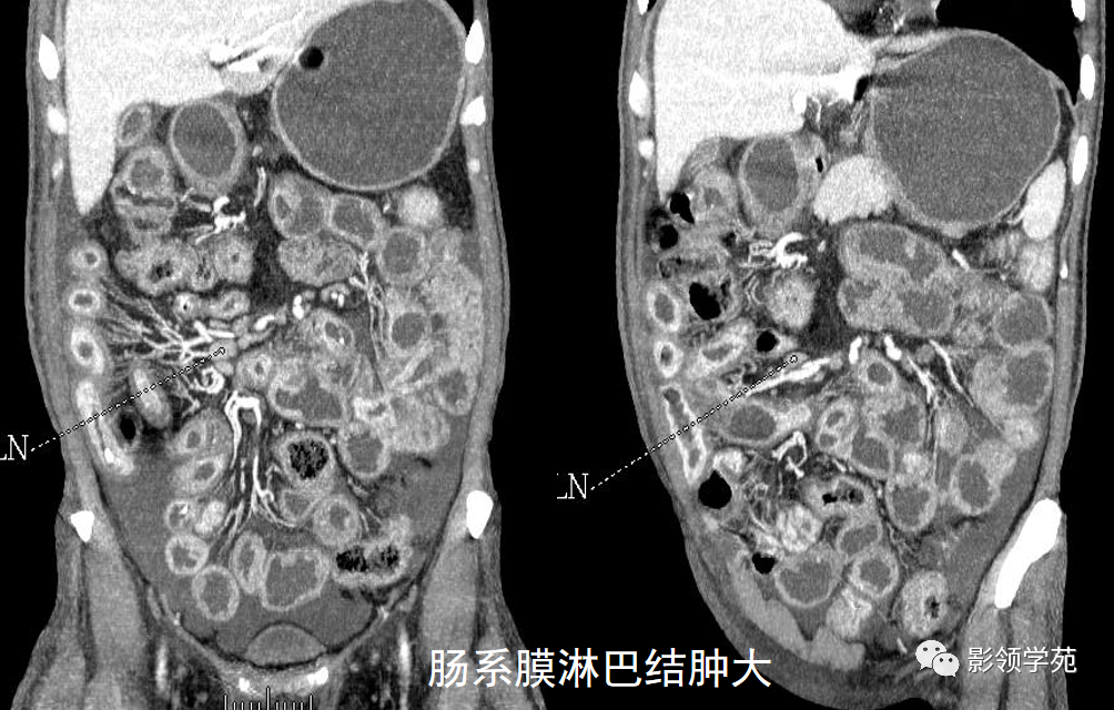 影像PPT - 炎症性肠病CT诊断-23