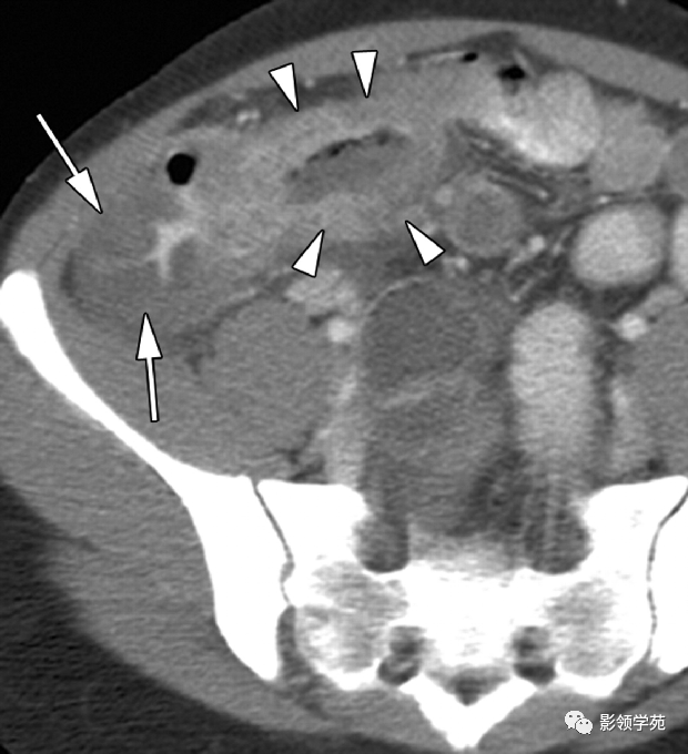 影像PPT - 炎症性肠病CT诊断-40
