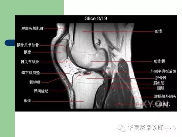 影像PPT - 【PPT】大关节MRI解剖-11