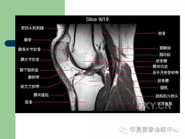 影像PPT - 【PPT】大关节MRI解剖-12