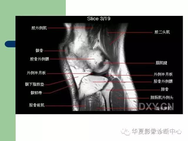 影像PPT - 【PPT】大关节MRI解剖-6