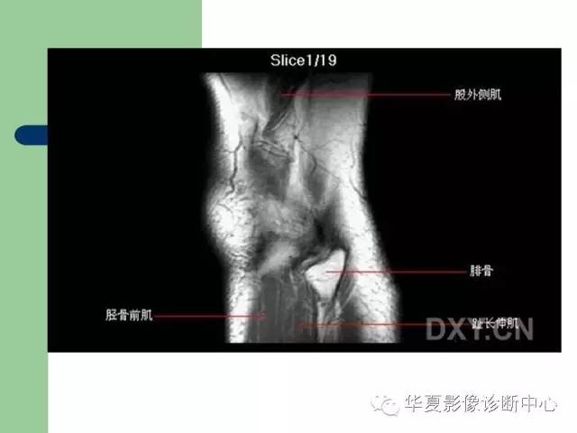 影像PPT - 【PPT】大关节MRI解剖-4