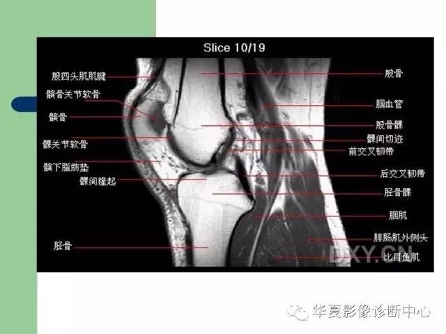 影像PPT - 【PPT】大关节MRI解剖-13