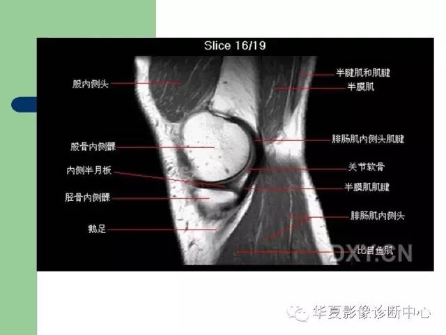 影像PPT - 【PPT】大关节MRI解剖-18