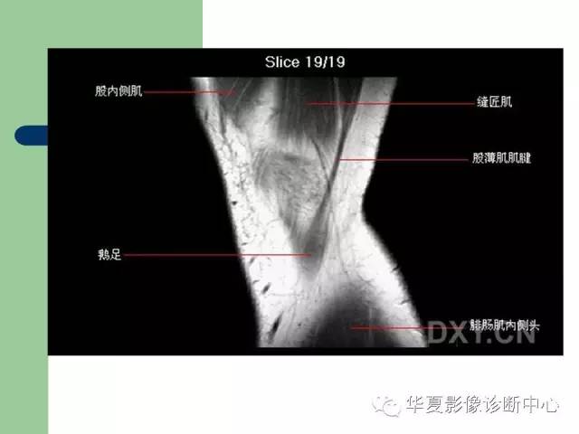 影像PPT - 【PPT】大关节MRI解剖-20