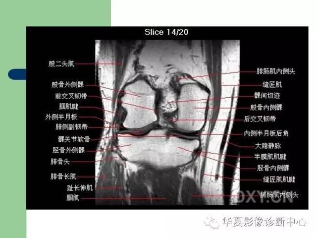 影像PPT - 【PPT】大关节MRI解剖-34