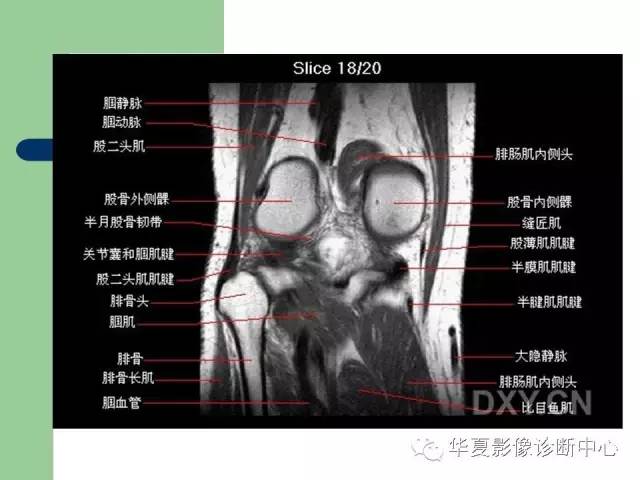 影像PPT - 【PPT】大关节MRI解剖-38
