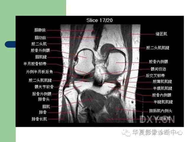 影像PPT - 【PPT】大关节MRI解剖-37