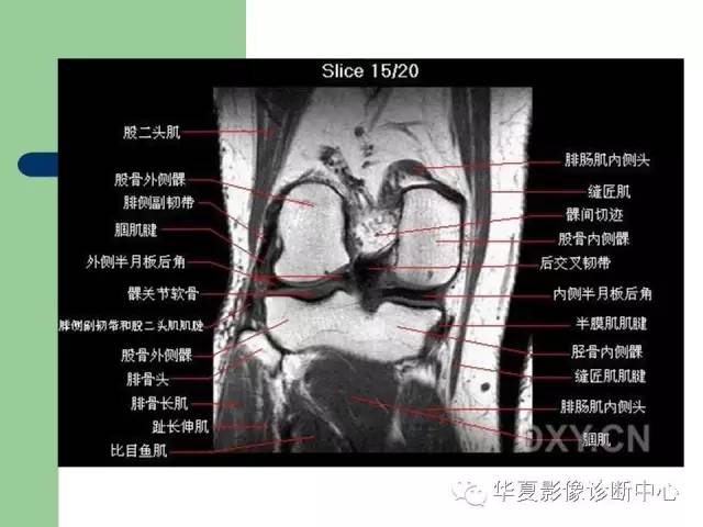 影像PPT - 【PPT】大关节MRI解剖-35