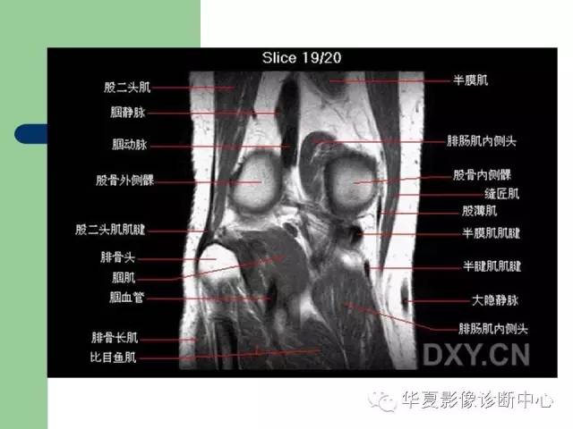 影像PPT - 【PPT】大关节MRI解剖-39