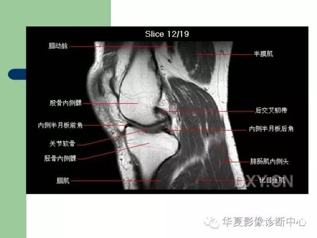 影像PPT - 【PPT】大关节MRI解剖-15