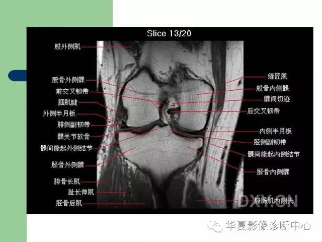 影像PPT - 【PPT】大关节MRI解剖-33