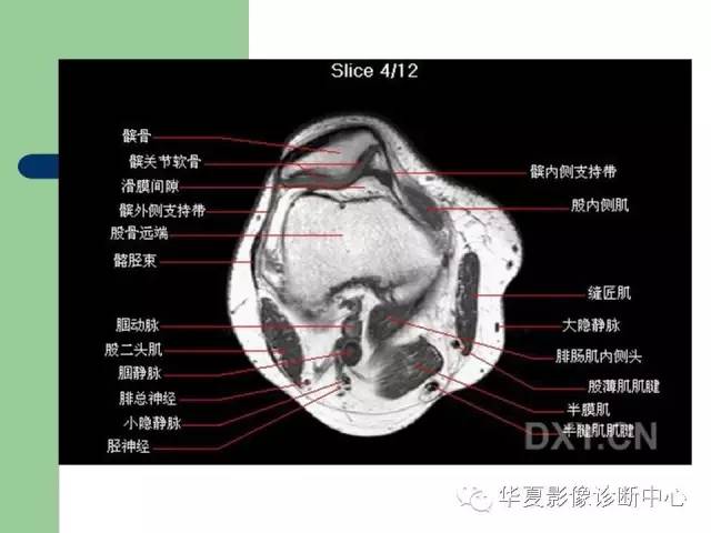 影像PPT - 【PPT】大关节MRI解剖-44