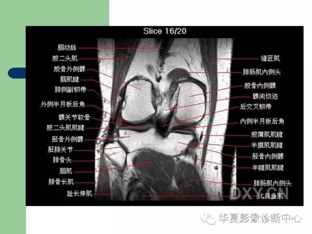 影像PPT - 【PPT】大关节MRI解剖-36