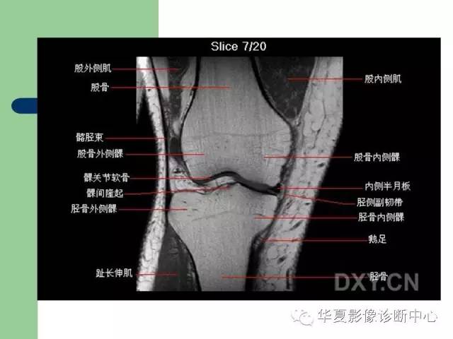 影像PPT - 【PPT】大关节MRI解剖-27