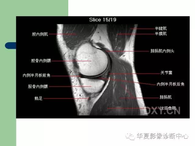 影像PPT - 【PPT】大关节MRI解剖-17