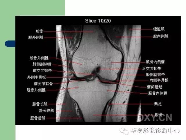 影像PPT - 【PPT】大关节MRI解剖-30