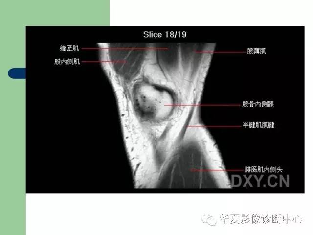 影像PPT - 【PPT】大关节MRI解剖-19