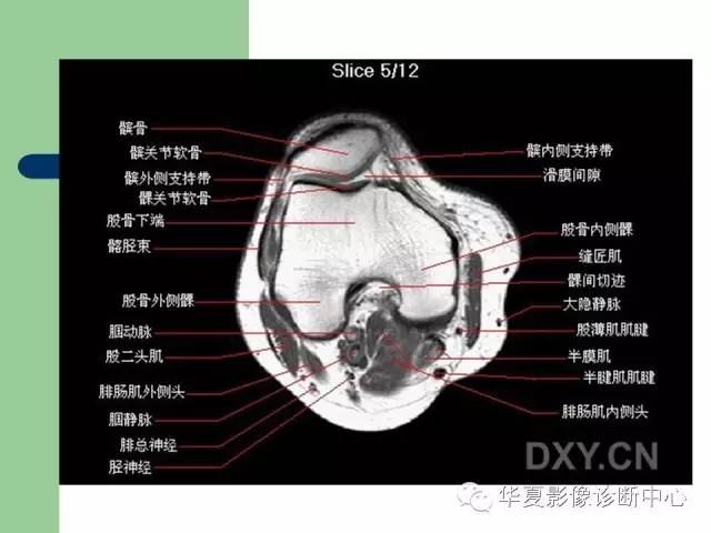 影像PPT - 【PPT】大关节MRI解剖-45