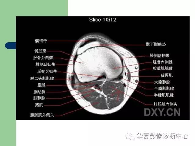 影像PPT - 【PPT】大关节MRI解剖-50