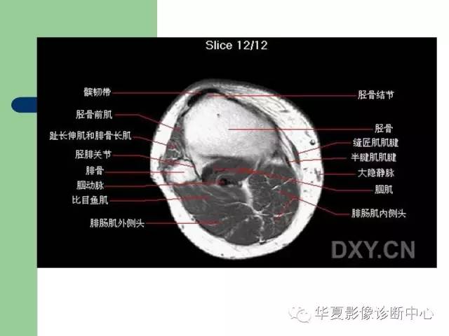 影像PPT - 【PPT】大关节MRI解剖-52