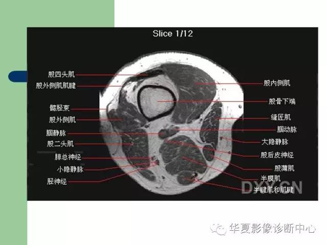 影像PPT - 【PPT】大关节MRI解剖-41