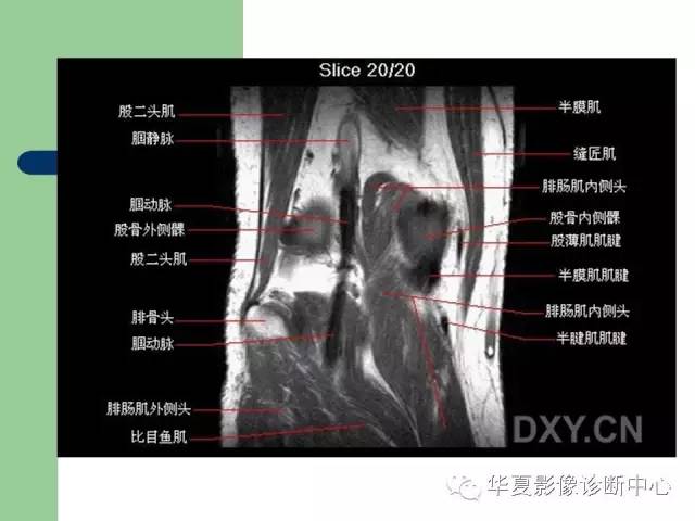 影像PPT - 【PPT】大关节MRI解剖-40