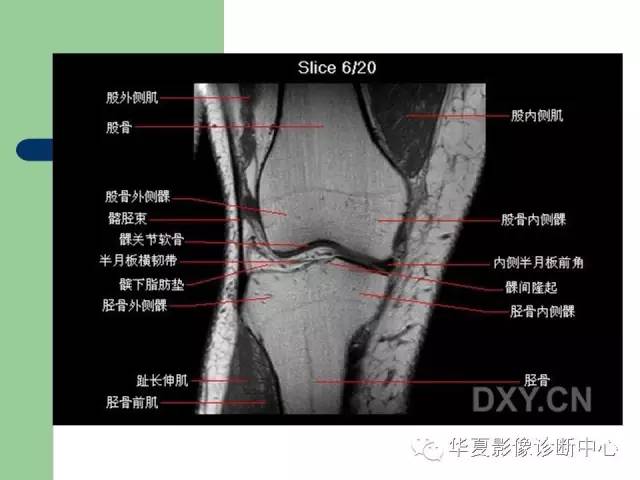 影像PPT - 【PPT】大关节MRI解剖-26