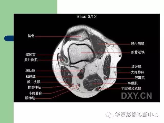 影像PPT - 【PPT】大关节MRI解剖-43