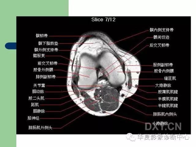 影像PPT - 【PPT】大关节MRI解剖-47