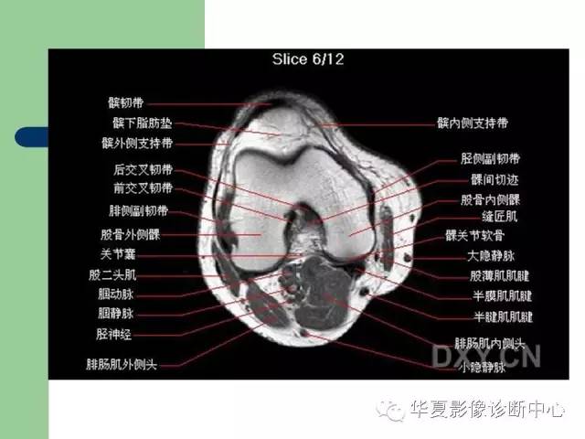 影像PPT - 【PPT】大关节MRI解剖-46