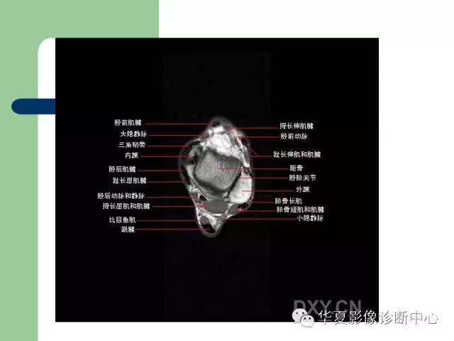 影像PPT - 【PPT】大关节MRI解剖-57