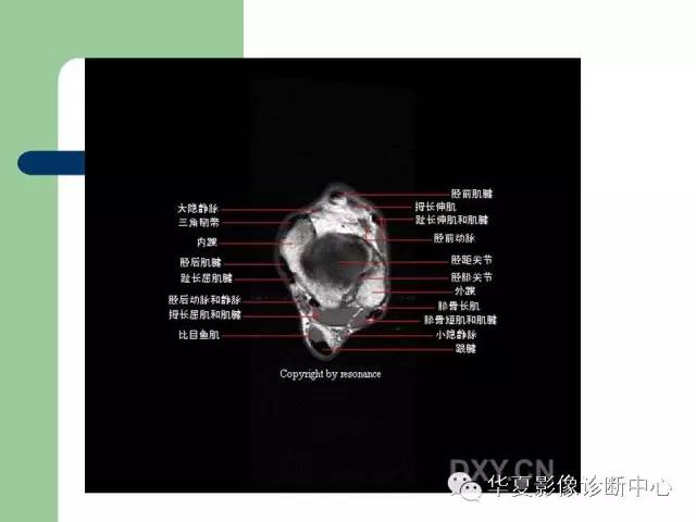 影像PPT - 【PPT】大关节MRI解剖-56