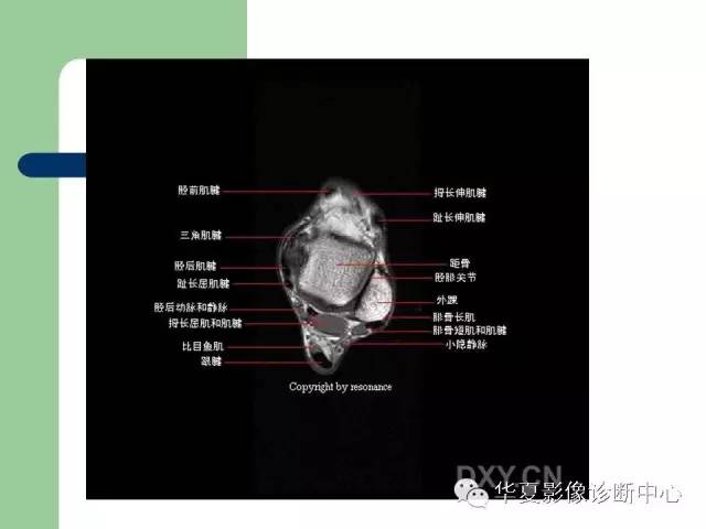 影像PPT - 【PPT】大关节MRI解剖-58