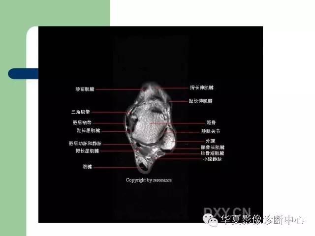 影像PPT - 【PPT】大关节MRI解剖-59