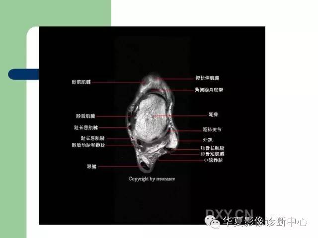 影像PPT - 【PPT】大关节MRI解剖-60