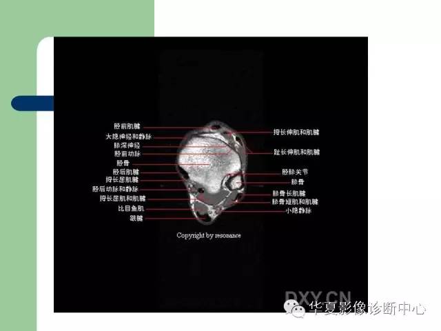 影像PPT - 【PPT】大关节MRI解剖-54