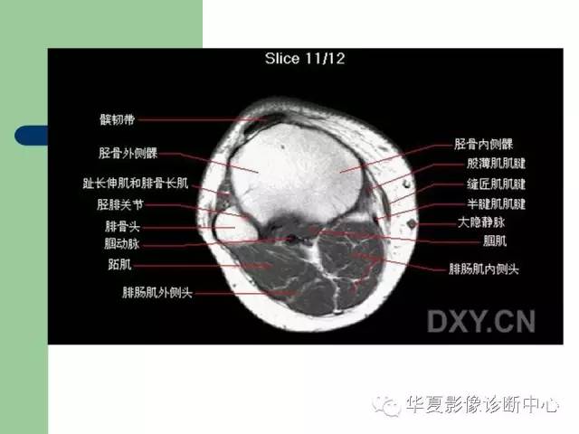 影像PPT - 【PPT】大关节MRI解剖-51