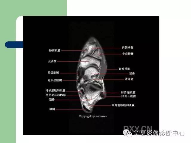 影像PPT - 【PPT】大关节MRI解剖-63