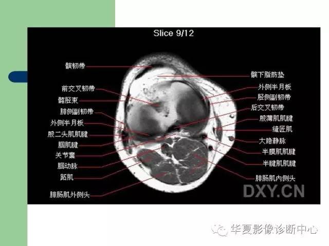 影像PPT - 【PPT】大关节MRI解剖-49