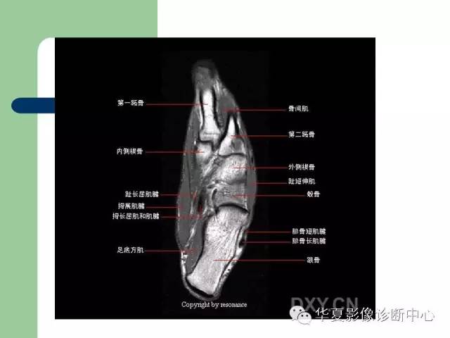 影像PPT - 【PPT】大关节MRI解剖-67
