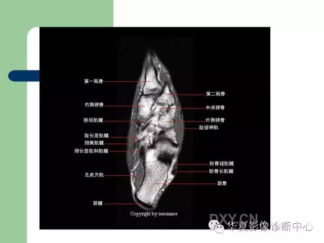 影像PPT - 【PPT】大关节MRI解剖-66