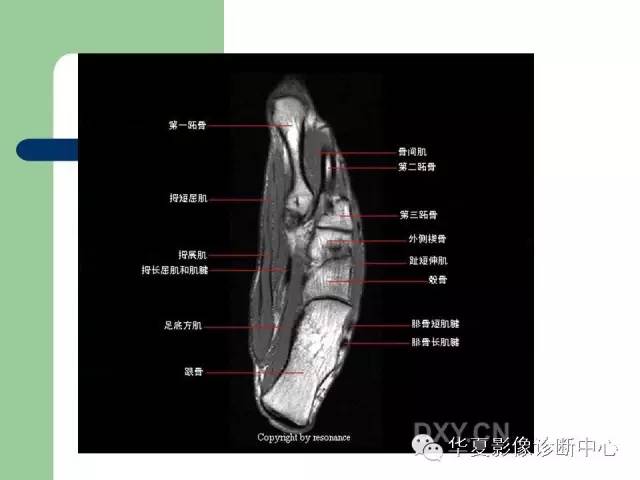 影像PPT - 【PPT】大关节MRI解剖-68