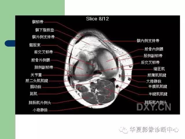 影像PPT - 【PPT】大关节MRI解剖-48