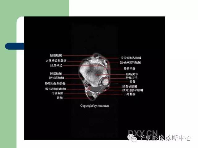 影像PPT - 【PPT】大关节MRI解剖-55