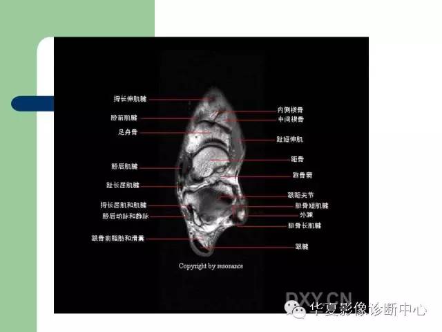 影像PPT - 【PPT】大关节MRI解剖-62
