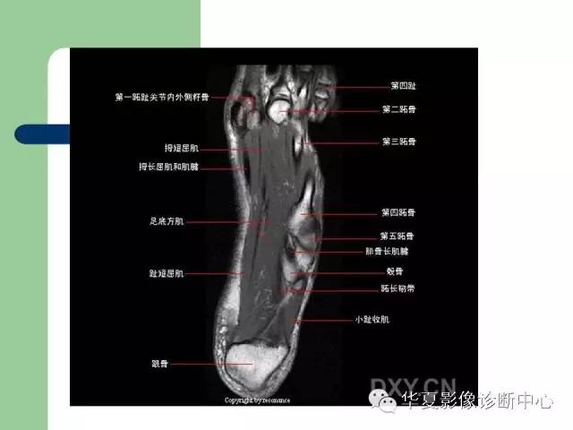影像PPT - 【PPT】大关节MRI解剖-71