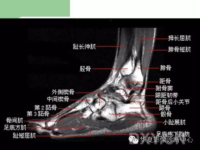 影像PPT - 【PPT】大关节MRI解剖-75