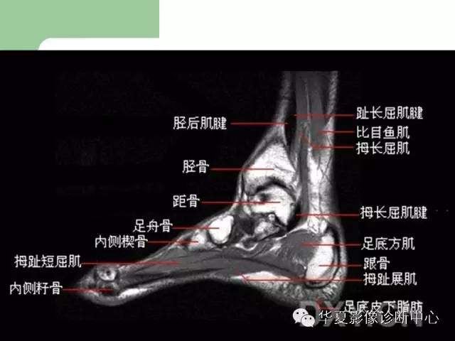 影像PPT - 【PPT】大关节MRI解剖-83